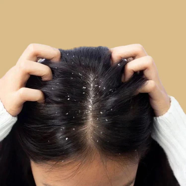 Anti-Dandruff